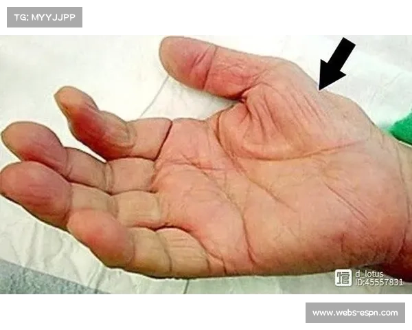 森林狼新秀香农左脚拇展肌拉伤，两周后重新评估伤势